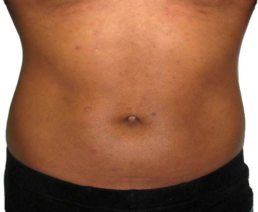 Male Mesotherapy - After