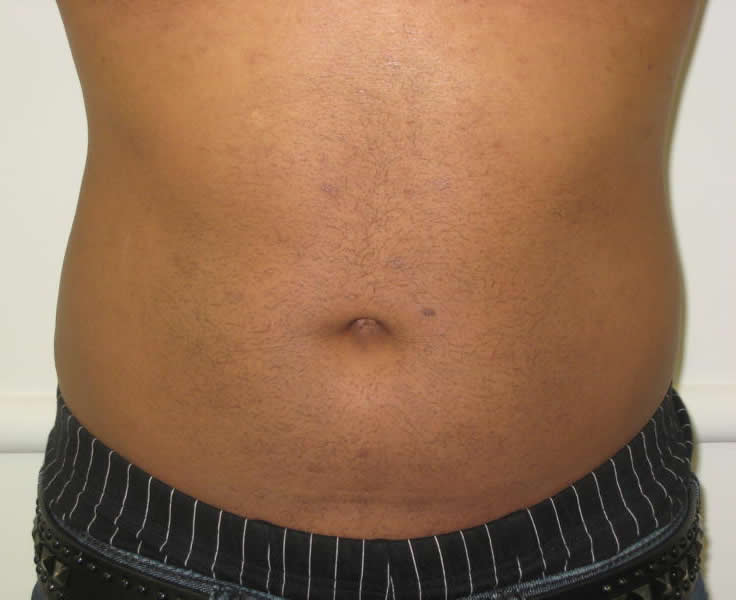 Male Mesotherapy - Before