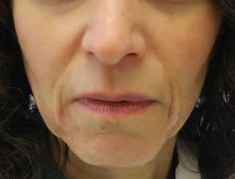 Restylane - Before